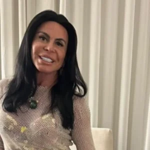 Gretchen exibe resultado de transplante capilar após diagnóstico de alopecia