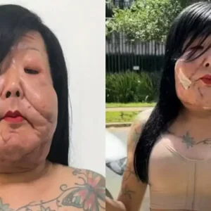 Juju do Pix: Médico mostra impressionante antes e depois 6 meses após reconstrução facial