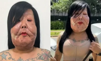 Juju do Pix: Médico mostra impressionante antes e depois 6 meses após reconstrução facial